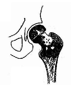 股骨干骺端结核，示空洞及不规则之小块死骨