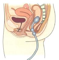 肛门直肠测压小气囊导管放置位置
