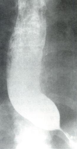 賁門失弛緩症的食管X線表現