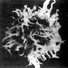 毛細胞性白血病細胞