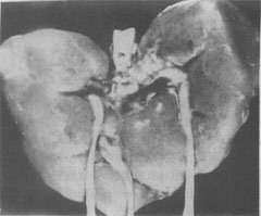 三體（Edwards）症候群的畸形腎
