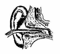 外耳道異物鑷取法