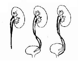 各種腎盂及輸尿管的重複畸形