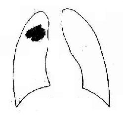 渗出性病变，其边缘模糊，与正常肺之间无明显的界限