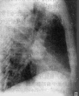 右肺中心型肺癌伴肺門淋巴結轉移