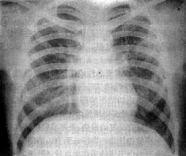 左肺浸潤型肺結核空洞形成