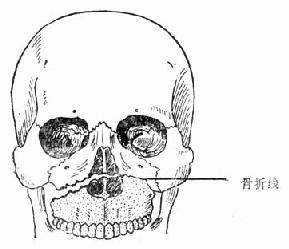 上頜骨骨折Ⅰ型