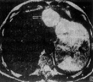 肝血管瘤（MRI）