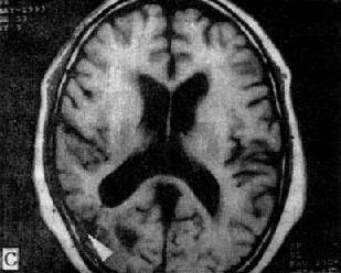 MRI掃描SE序列圖像