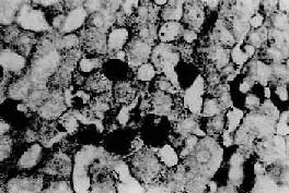 肝細胞內的B型肝炎表面抗原
