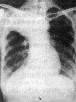 右上叶支气管肺癌