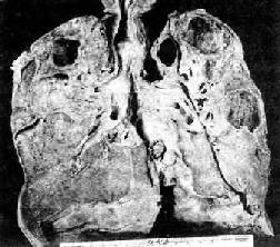 慢性纖維空洞型肺結核病（冠狀切面）