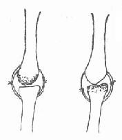 保留掌骨或近節指骨有完整關節面之一端，修整另一端，縫合關節囊，形成假關節