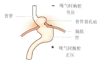 食管裂孔疝對胃食管連接處解剖結構的影響