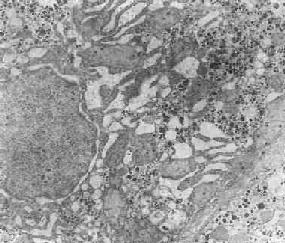 肝细胞粗面内质网扩张