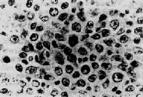 小无核裂滤泡中心细胞型淋巴瘤—非Burkitt淋巴瘤