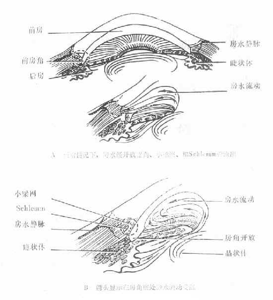 开角型青光眼