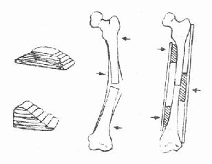 股骨骨折牽引加小夾板三點壓墊法保持對位