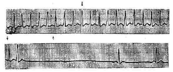 室上性心動過速（與上相連）壓迫頸動脈竇使發作終止