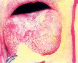 白斑癌變(舌背)