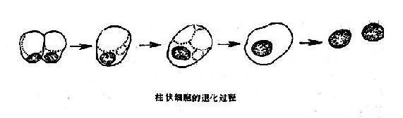 退化變性的柱狀細胞與腺癌細胞示意圖