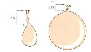 用氣球來比擬胃：胃過度擴張致LES變短