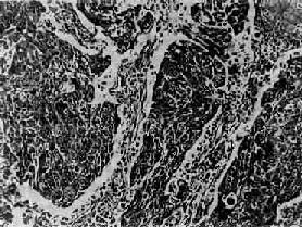 肺低分化鱗狀細胞癌