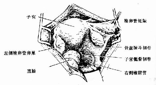 右側輸卵管妊娠