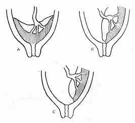 前置胎盤分類