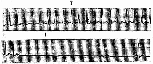 室上性心动过速（两条相连）压迫颈动脉窦使发作终发作终止