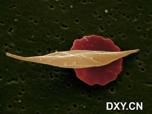 鐮狀細胞貧血癥血紅細胞
