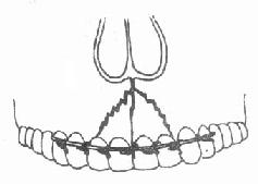 牙槽突骨折和牙弓夾板結紮固定