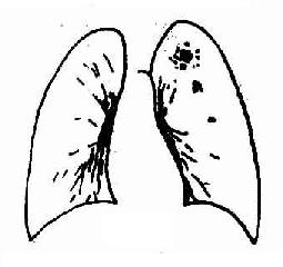 左上浸潤型肺結核，鎖骨上區浸潤，軟性病灶。