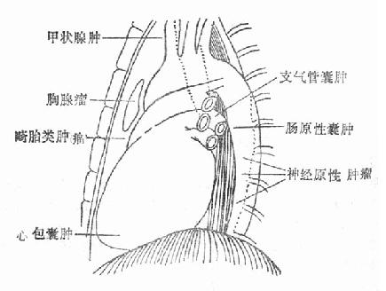 縱隔腫瘤及囊腫多發部位示意圖