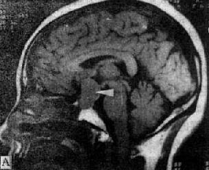 MRI掃描SE序列圖像