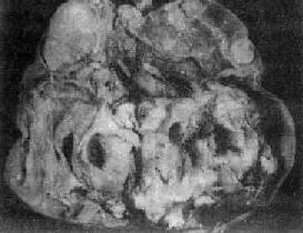 卵巢囊性畸胎瘤