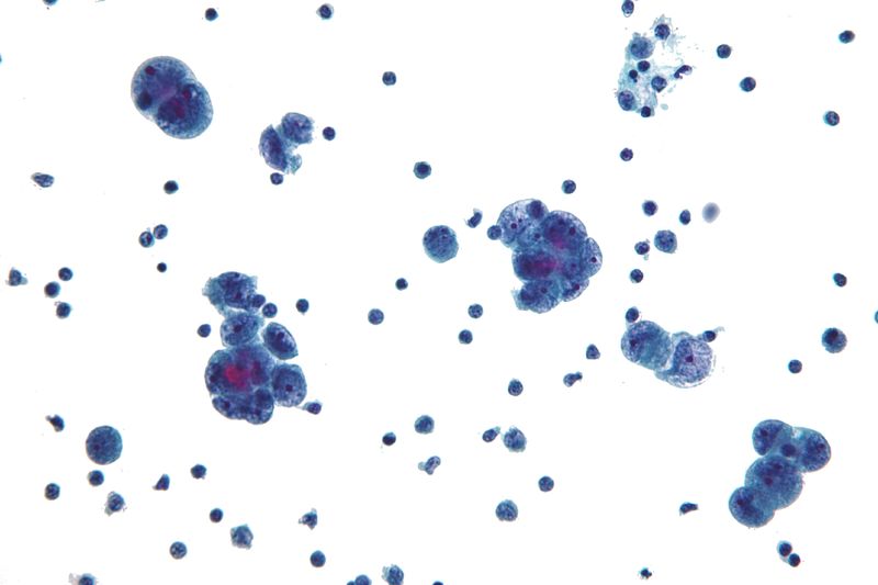文件:Serous carcinoma cytology.jpg