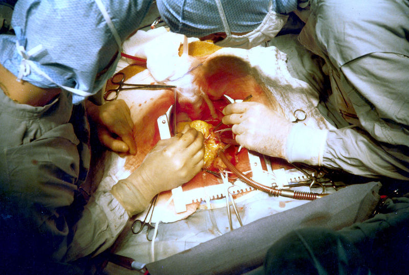 文件:Coronary artery bypass surgery Image 657B-PH.jpg