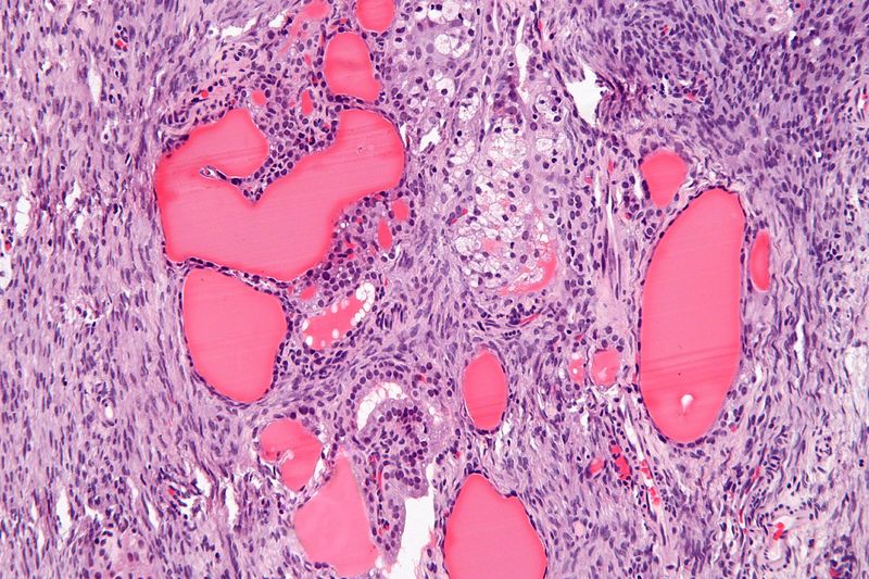 File:Struma ovarii - high mag.jpg