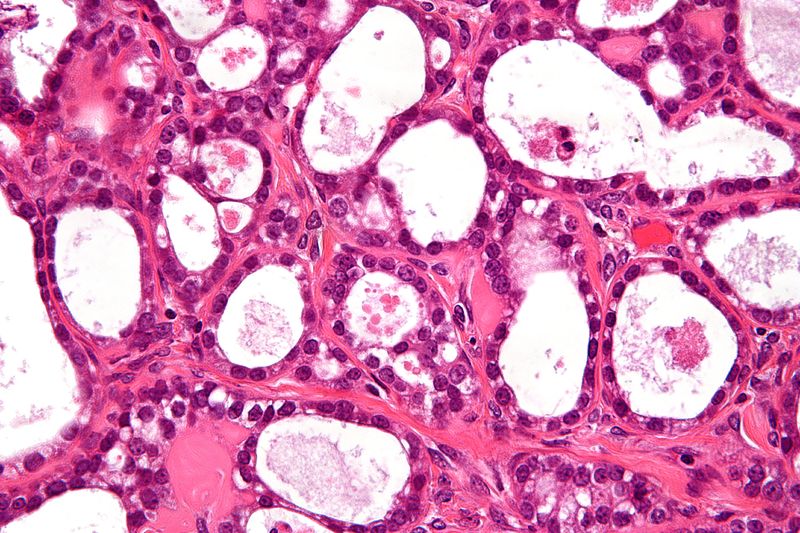 文件:Ovarian clear cell carcinoma -a- very high mag.jpg