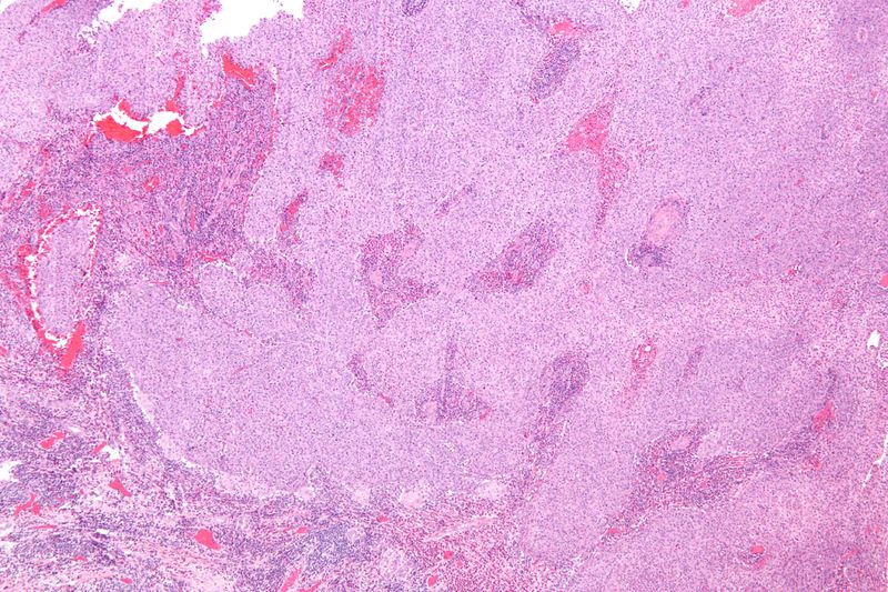 文件:Glassy cell carcinoma - low mag.jpg