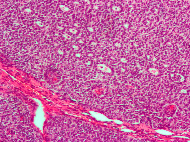 文件:Granulosa cell tumour2.jpg