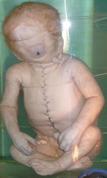 File:Child with Cyclopia.jpg