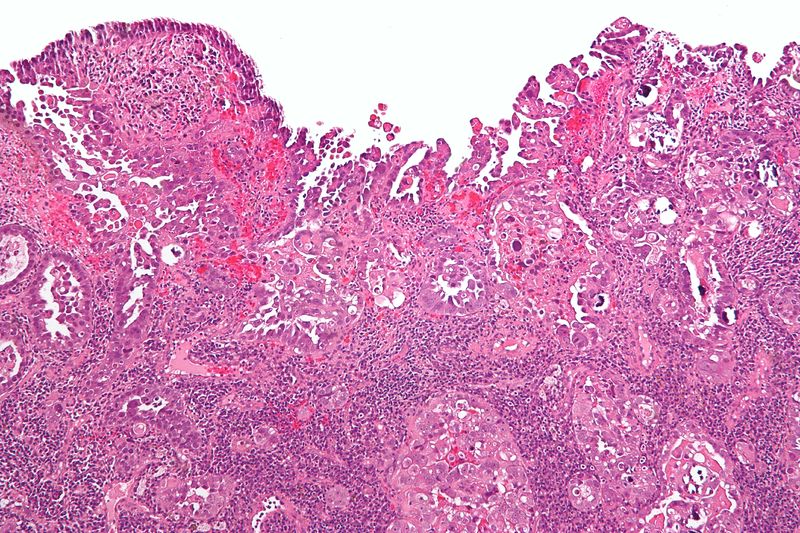 文件:Uterine papillary serous carcinoma low mag.jpg