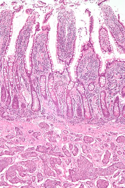 文件:Small intestine neuroendocrine tumour low mag.jpg