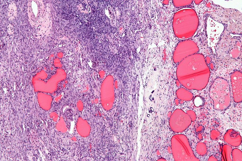 File:Struma ovarii - intermed mag.jpg