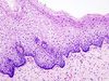 Cervical intraepithelial neoplasia (1) normal squamous epithelium.jpg