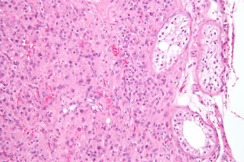 File:Leydig cell tumour2.jpg