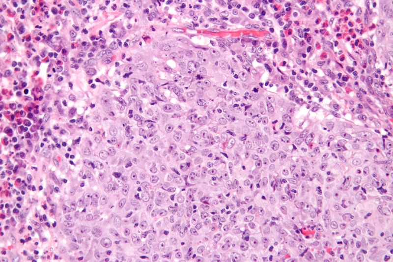 文件:Glassy cell carcinoma - very high mag.jpg