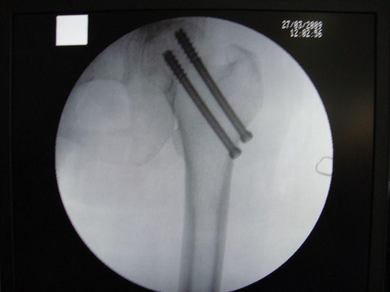文件:股骨颈骨折X光.jpg